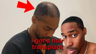 I Went To Turkey and Got A Hair Transplant