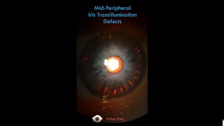 Mid-peripheral Iris Transillumination Defects - see on Retroillumination