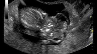 acrania 11 weeks transvaginal ultrasound video