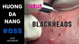 #055 | the fastidious guy's blackheads | Being recorded before Social distancing