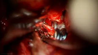 Ophthalmic Artery Aneurysm Clipping via Pterional Craniotomy with Extradural Anterior Clinoidectomy