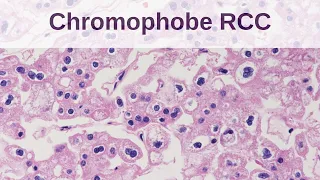 Chromophobe Renal Cell Carcinoma