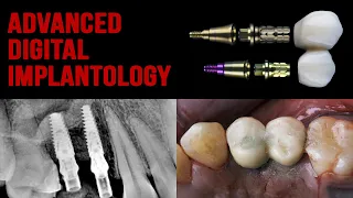 Connect system  - Оne time One abutment - Vista technique  - Crystal sinus lifting