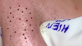 Satisfying Hien Spa Beauty Relaxing Video #13