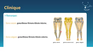 GONARTHROSES -  Dr Remilaoui - TeebPedia