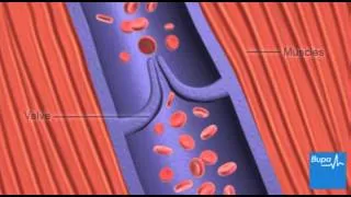 How deep vein thrombosis (DVT) forms