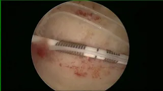 HYSTERSCOPIC Copper T removal