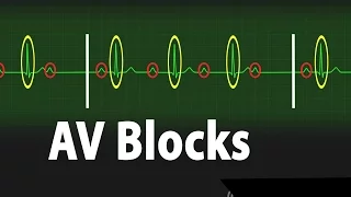 Atrioventricular Block (AV block) - Types of Heart Block Part 2, Animation.