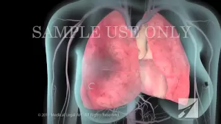 Deep Vein Thrombosis (DVT) and Pulmonary Embolism (PE)