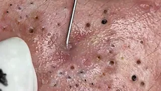 Removal Hidden Blackheads At Loan Nguyen Spa | 34