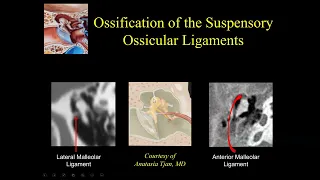 Suresh Mukherji.  Imaging of Conductive Hearing Loss