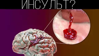 Что происходит во время инсульта? | ПОЛЕЗНЫЙ ЮТУБ