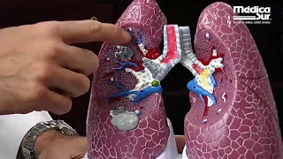 Daño respiratorio por contaminación ambiental y partículas PM 2.5