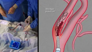 Extracranial Thrombectomy with eSAVE