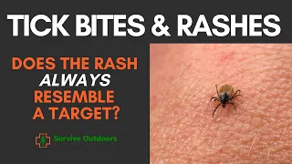 Two RASHES one TICK - How to Identify a Tick Rash