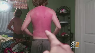First Aid Tips For Nasty Sunburns