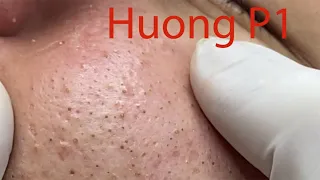 Make your Acne Treatment Huong Da Nang#490 part 1 | acne 2022