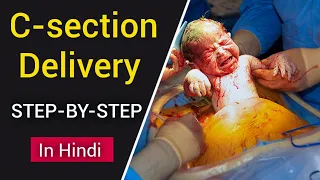 C-section (Cesarean Delivery) | Cesarean Delivery Explained In Hindi | ScienceGenome