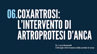 6 - COXARTROSI - L'intervento di artroprotesi anca - Dr. Luca Busanelli