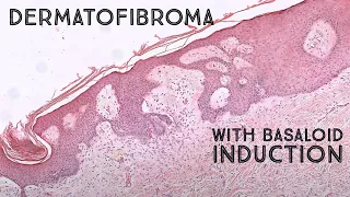 Dermatofibroma with basaloid follicular induction (mimic of basal cell carcinoma) pathology