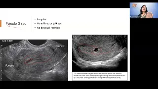 Early pregnancy basics of Ultrasound