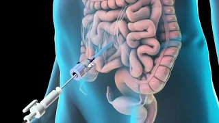 Laparoscopic Lysis of Abdominal Adhesions (2011)