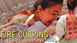 Fire Cupping & Acupuncture for Chronic Pain | ASMR soft-spoken Real Doctor consultation