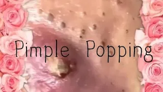 Pimple & Blackheads Popping - 25