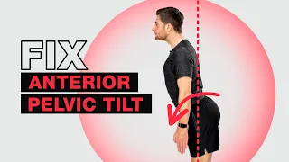 Fix Anterior Pelvic Tilt – Fast!