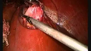 Lap Hydatid Cyst excision