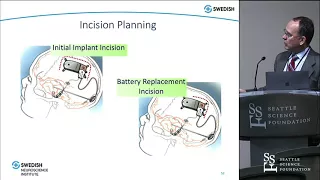 Responsive Neurostimulation for Epilepsy - Ryder Gwinn, MD