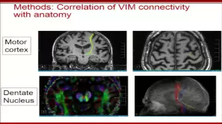 Krishna - Tractography-based VIM identification for focused ultrasound thalamotomy (2016)