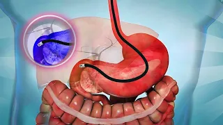 ERCP (endoscopic retrograde cholangiopancreatography) -Procedure 3D Animation