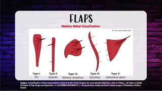 Episode 11: ISR Microsurgery and Flaps