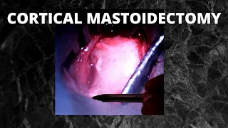 069. Cortical Mastoidectomy   #Schwartz's operation  #surgeryeducation