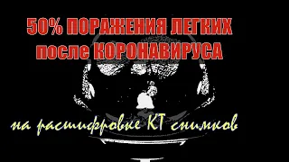 50% ПОРАЖЕНИЯ ЛЕГКИХ на КТ после КОРОНАВИРУСА при полисегментарной двухсторонней пневмонии