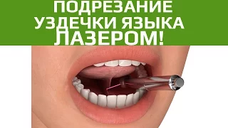 Хирургическая стоматология. Подрезание уздечки языка и губы