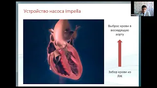 Острая правожелудочковая сердечная недост Аветисян Э.А.