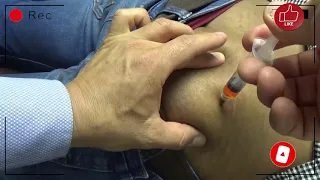 Inyección Intramuscular