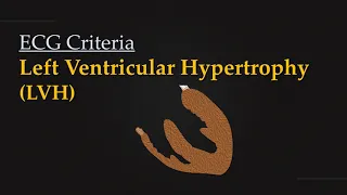 ECG Criteria for Left Ventricular Hypertrophy (LVH)