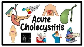 Gallbladder Guide: All You Need to Know About Acute Cholecystitis!