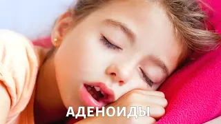 Что такое аденоиды и как их лечить?