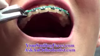 Removing Braces - AskAnOrthodontist.com