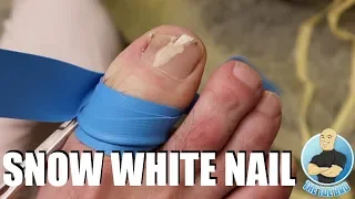 WINTER WHITE FUNGAL TOENAIL REMOVAL