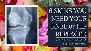 6 Signs You Need Knee or Hip Replaced. Questions to Ask Your Doctor.