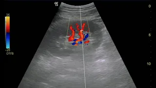 Renal Doppler Ultrasound