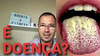 LINGUA BRANCA MESMO ESCOVANDO É SUJEIRA ou DOENÇA?