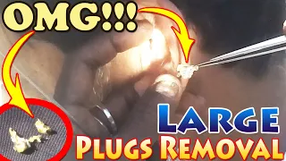 Painful FUNGAL Impacted Plugs Earwax Removal / Letest Ear Cleaning by Roadside Ear Cleaner