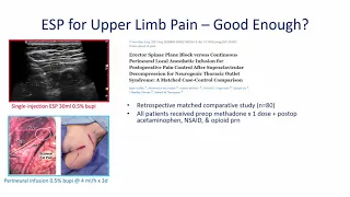 Erector Spinae Plane (ESP) Block for Upper Limb Pain