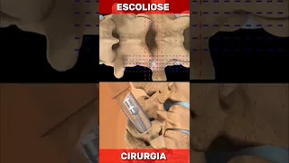 CIRURGIA DE ESCOLIOSE